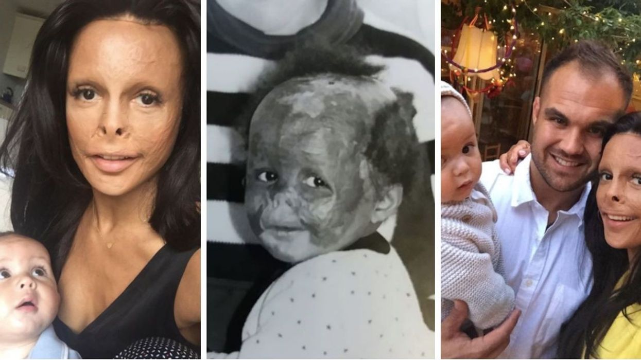 Woman Learns The Life-changing Truth Behind Her Burn Scars