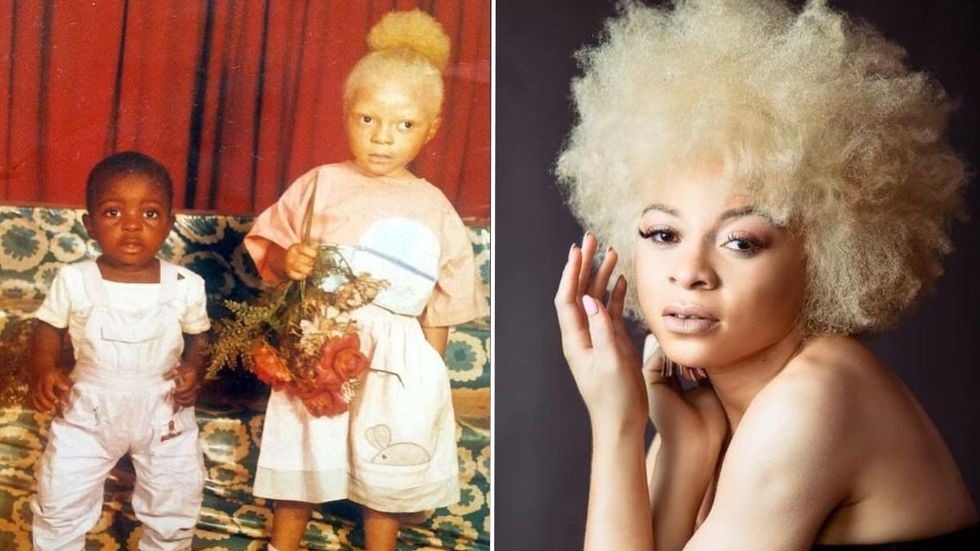 Girl Is Bullied for Her Cursed Skin - Today, After Proving Everyone Wrong, She's Become a Famous Model