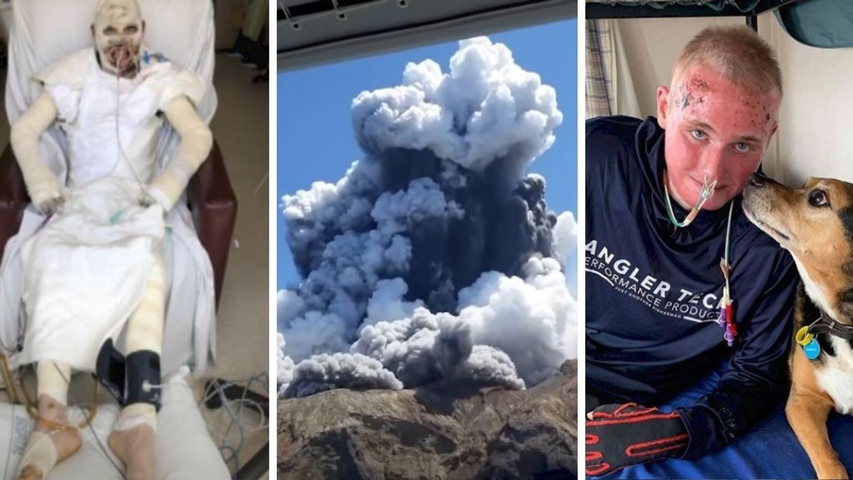 Young Man Who Survived Horrific Volcano Eruption Reveals Heroic Journey Back To Health