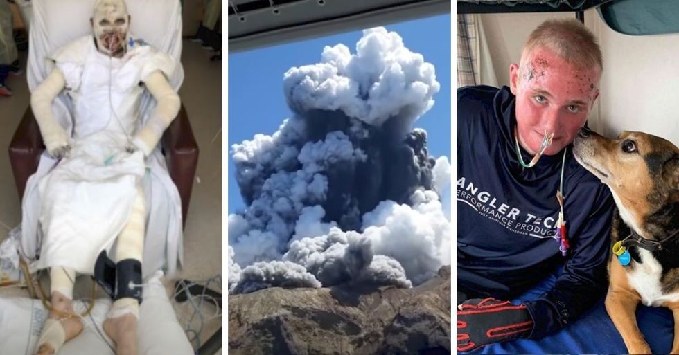 Young Man Who Survived Horrific Volcano Eruption Reveals Heroic Journey Back To Health