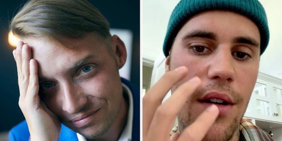 Justin Bieber and Mike Shoreman Ramsay Hunt Syndrome