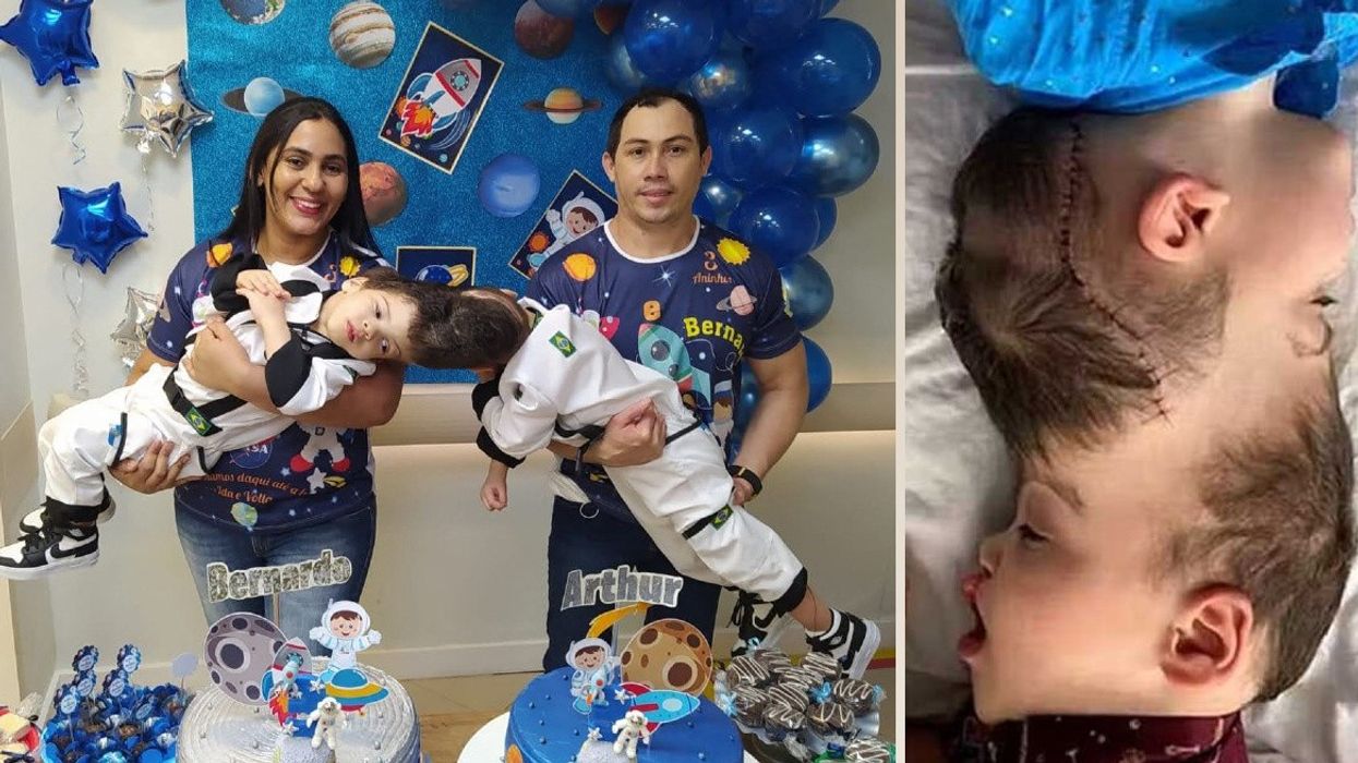 Family of 3-Year-Old Conjoined Twins Told Surgery Was Impossible — How They Defied Odds and Made Magic Happen