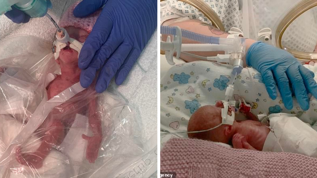 Doctors Weren't Sure 1-Pound Baby Would Survive - So They Did The Unimaginable And It Worked