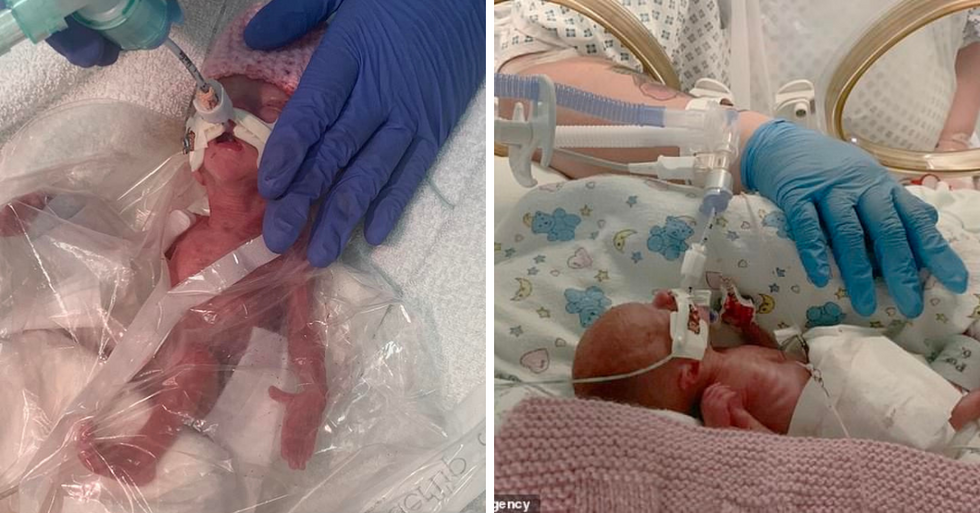Doctors Weren't Sure 1-Pound Baby Would Survive - So They Did The Unimaginable And It Worked