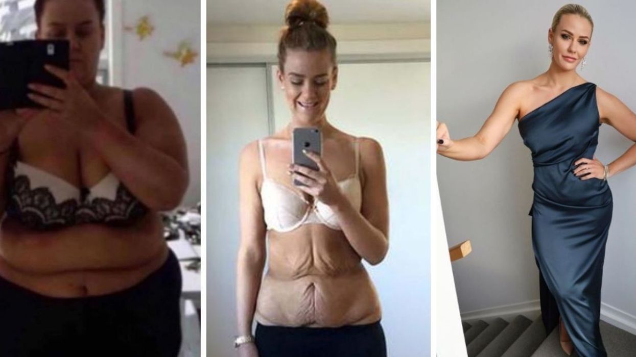 At 372 lbs, She Went From Struggling To Move Around To Being 200 lbs Lighter