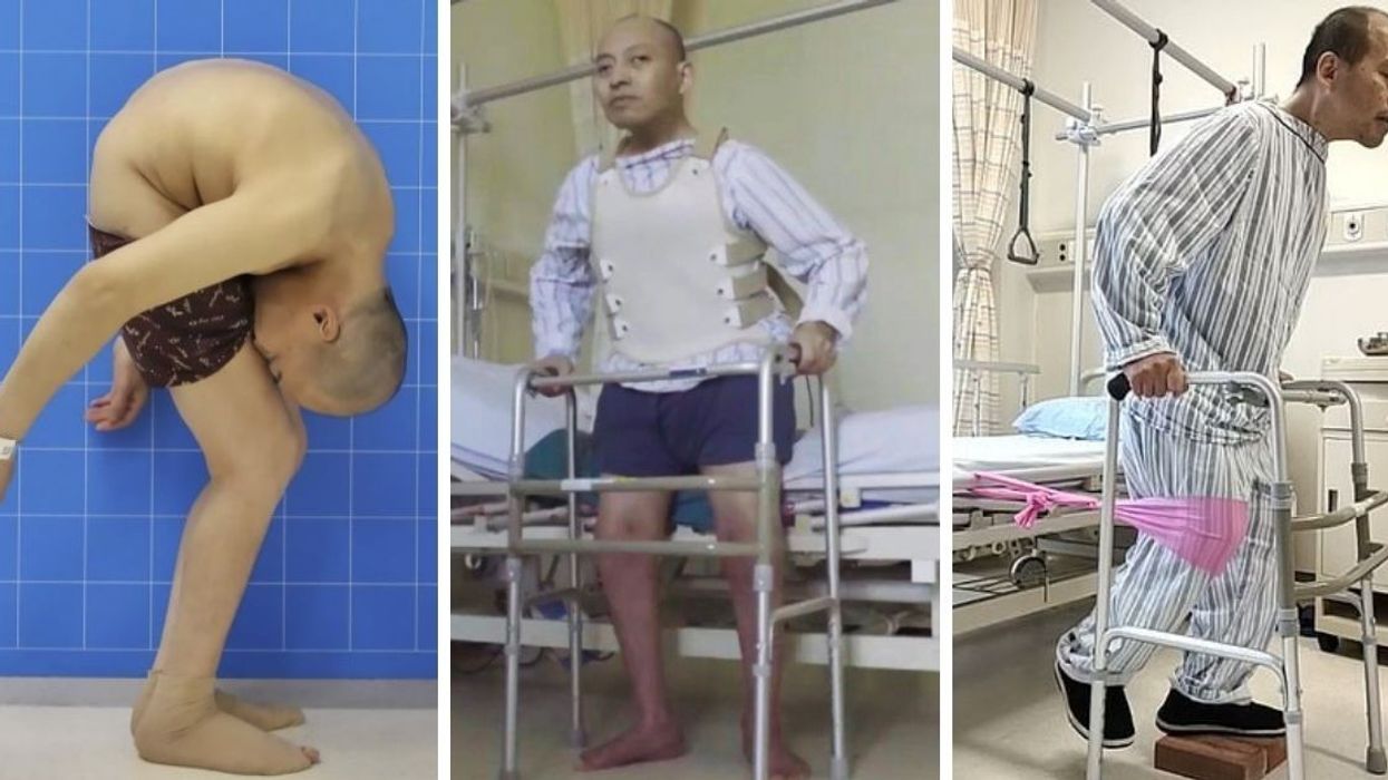 After 28 Years, 'Folded Man' Finally Stands Straight Thanks To One Doctor Who Never Gave Up