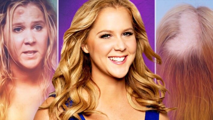 Amy Schumer hair pulling disorder