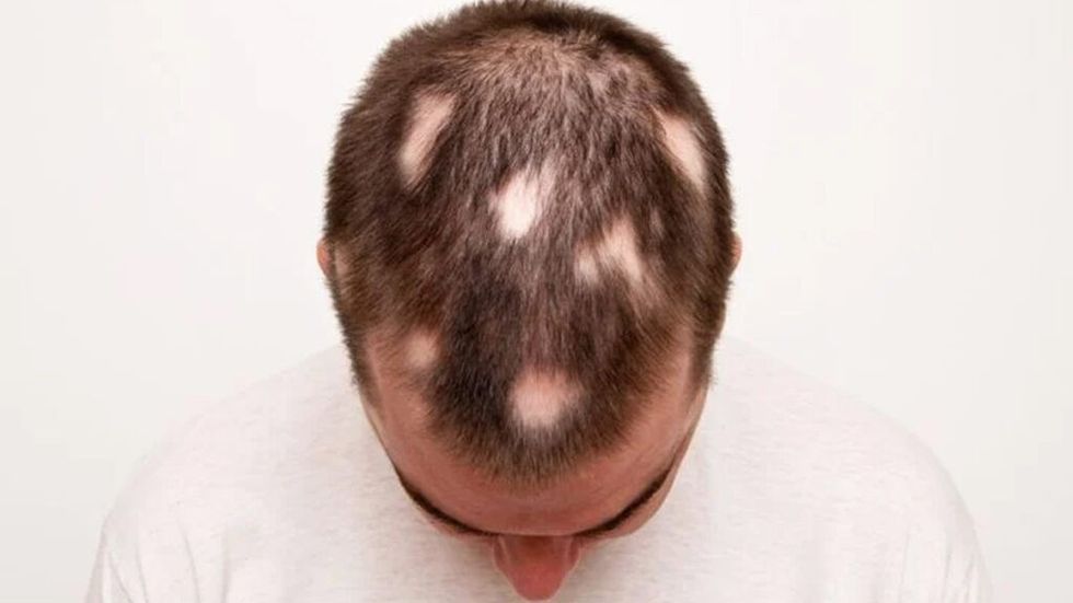 Man showing bald patches on head