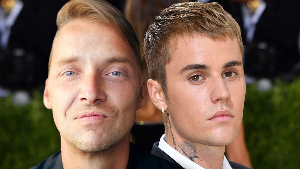 Justin Bieber Hair Loss: Everything You Need To Know - Wimpole Clinic