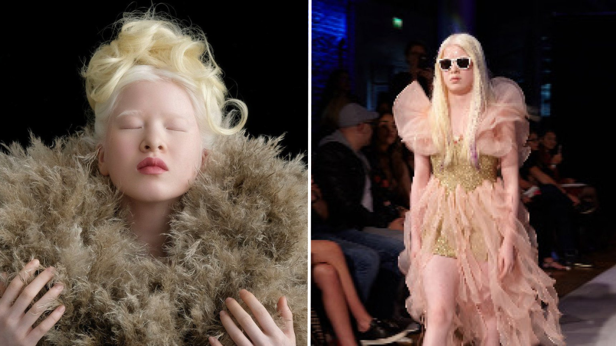 woman with albinism models for Vogue